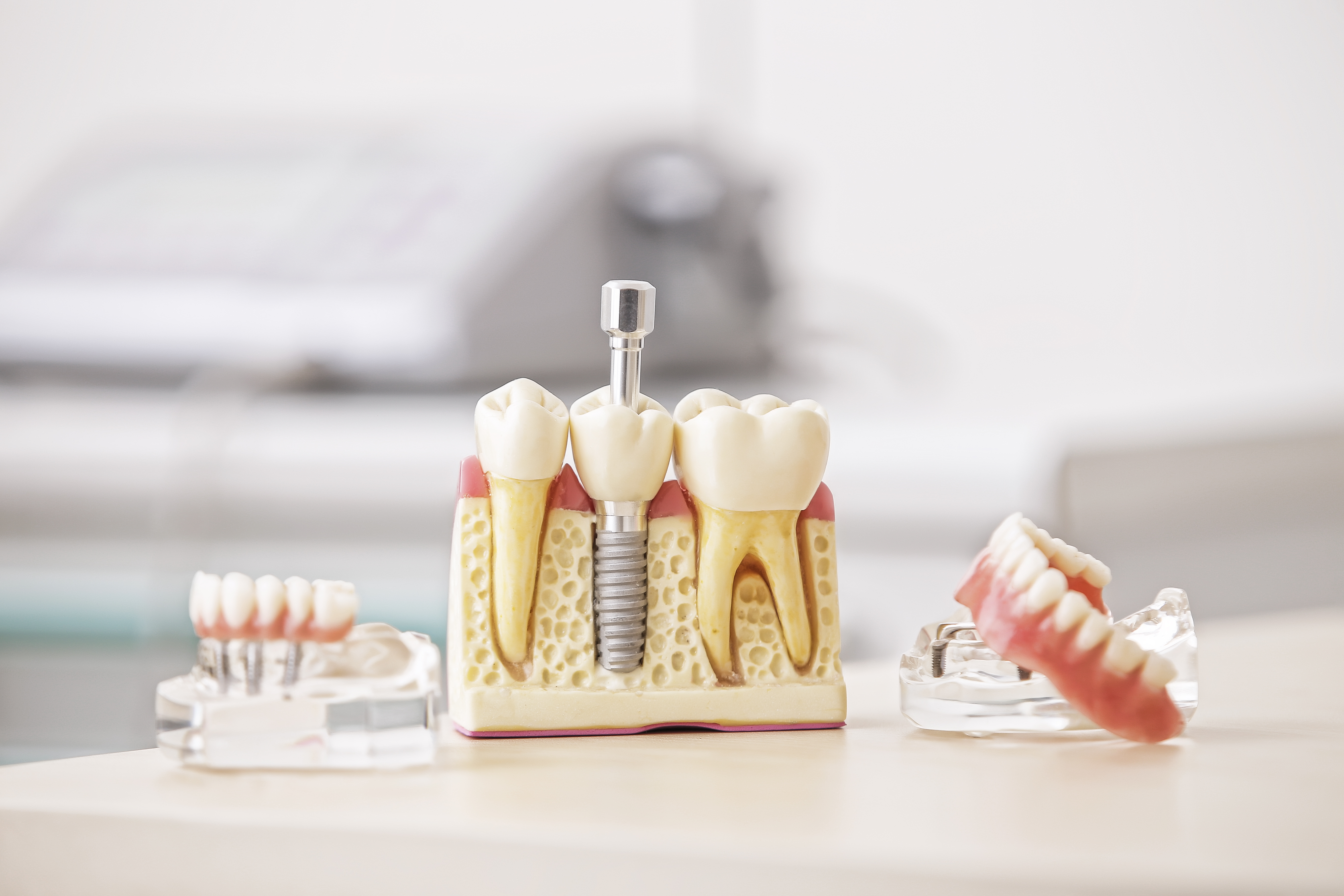 Você sabe como cuidar dos seus implantes dentários?